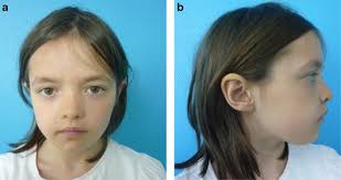 A new mutation in the C-SH2 domain of PTPN11 causes Noonan syndrome with  multiple giant cell lesions