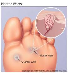 Check spelling or type a new query. Plantar Warts What They Are And How To Treat Them Foot Care Products Footdocstore