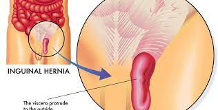 Check spelling or type a new query. Hernia Inguinal Sintomas De Una De Las Hernias Mas Frecuentes