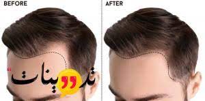 زراعة الشعر في جدة بكم حيث التعرف على متوسط تكلفة تلك العملية والتعرف على المراكز الهامة