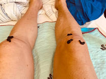 Leech Therapy product image