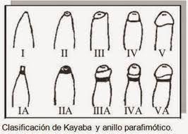 Fimosis Circuncision Cremas De Corticoides Y Tirones