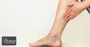 Image result for Pigment stains on the shin