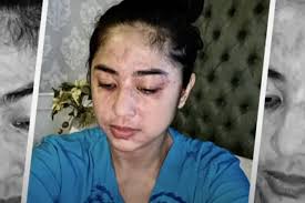 December 25th, 12:43 pm december 25th, 12:43 pm gading perkasa © disediakan oleh kompas.com dewi perssik sedang berbincang dengan deddy corbuzier. Covid 19 Penipu Ulung Ahli Ungkap Ruam Pada Dewi Perssik