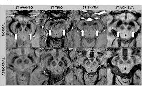 Dementia with lewy bodies, parkinson disease, and alzheimer disease overlap considerably. Pdf Mri Of The Swallow Tail Sign A Useful Marker In The Diagnosis Of Lewy Body Dementia Semantic Scholar