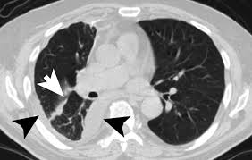 Desmoplastic mesothelioma can be challenging for your pathology report will describe the number of lymph nodes examined. Pathology Outlines Diffuse Malignant Mesothelioma