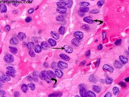 Check spelling or type a new query. Ijkpathology Aiimsmay2018 Dr Ila Jain Khandelwal Facebook