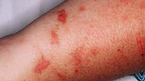 Maybe you would like to learn more about one of these? Phytophotodermatitis Symptoms Causes And More