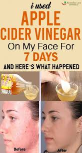 I Used Apple Cider Vinegar On My Face For 7 Days And Here S What Happened Remedies Lor Apple Cider Vinegar For Skin Apple Cider Vinegar Face Vinegar For Hair