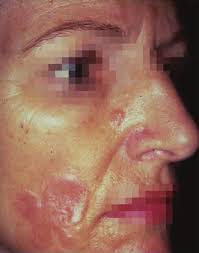 The tuberculosis cutis luposa had been misdiagnosed as cutaneous leishmaniasis and surgically treated. 2