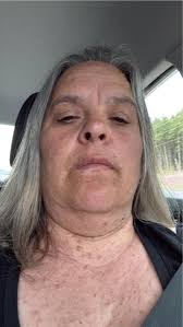 I've actually found somebody with NF what a wonderful gift don't have to  explain thank you Stephanie Easton 🌹