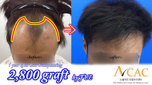 Hair transplantation is a transferred process made of the healthy hair that has not been lost and is in the back and sides of the head, to the regions having healthy hair losses. Fue Hair Transplant For Asian Nobleline Asian Hair Transplant Clinic Youtube