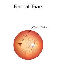 This pushes the retina into place so it can heal properly. Signs Of A Torn Retina Shawnee Ks