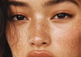 Image result for Freckles