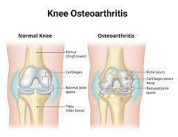 Image result for Knee Bulge Sign