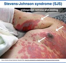 Image result for skin rash acute hiv infection