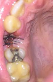 Image result for Alveolitis sicca)