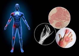 Bessere Therapie Bei Psoriasis Arthritis Durch Biologika