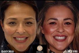 VICI Dental Gallery: Patient Smile Transformations In Leeds