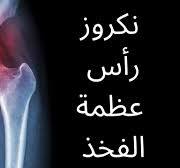 ‫نكروز ( تنخر) رأس عظمة الفخذ‬‎
