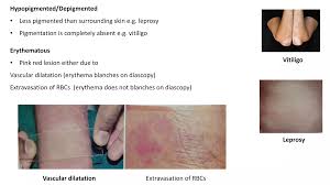 Image result for Diascopy