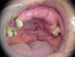 Image result for Erythroplakia roof of mouth