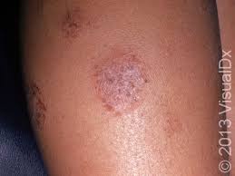 Image result for Eczema nummulare