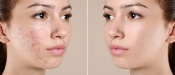 Image result for acne face