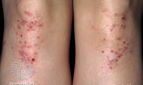 Image result for Rhus Dermatitis