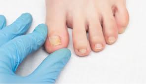 Image result for mykoza nehtů