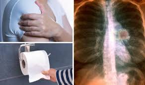 Lung cancer (cancer of the lung) is common worldwide. Lung Cancer Symptoms 10 Unexpected Signs Of A Lung Tumour You Might Be Ignoring Ny Press News