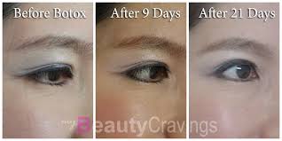 Botox won't help with wrinkles caused by sun damage or. Review Erase Under Eye Wrinkles With Botox Mybeautycravings