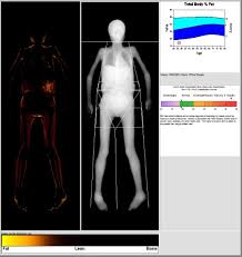 Image result for Lipodystrophy