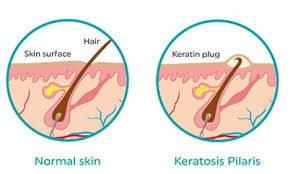 Keratosis pilaris (kp) is a common skin condition that appears as tiny rough bumps on the skin. Keratosis Pilaris Treatment In Our Clinic Book A Consultation