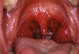 It is impossible to be a truly healthy person who smokes. Inside Of Mouth Showing Normal Throat And Tonsils Stock Image P492 0015 Science Photo Library