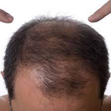 The hair can fall out in patches, all at once or just simply become thinner all over the scalp. Why Do Guys Lose Their Hair Part 3 Traumatic Hair Loss Hair Transplant Dubai