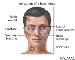 The first 24 hours after mild blunt force trauma to the head are particularly important because subdural. Head Injury First Aid Medlineplus Medical Encyclopedia