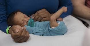 Image result for Clubfoot