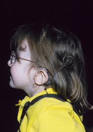 What Is CHARGE Syndrome?