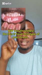 Thrush in Mouth Symptoms