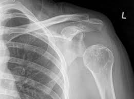 Image result for Shoulder Subluxation