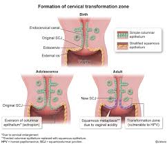 Image result for Acute Cervicitis