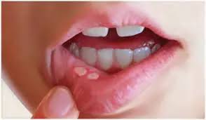 Image result for Canker sores symptoms roof of the mouth
