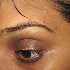 But you can die it! Warts Along The Eyebrows Download Scientific Diagram