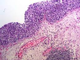 The Bladder Carcinoma Secondary To Schistosoma Mansoni Infection A Case Report With Review Of The Literature Sciencedirect