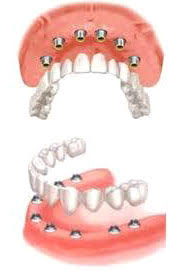 Notre clinique dentaire hongrie dispose des dernières technologies pour traiter nos patients helvétiques dans les meilleures conditions de confort et d'efficacité. Bridge Sur Implant En Hongrie