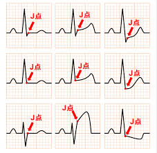 Image result for J Point