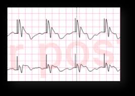 Image result for Transcutaneous Pacing