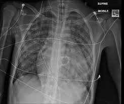 Image result for XRay Changes in Rheumatic Conditions