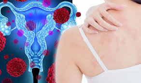 Ovarian cancer stages range from stage i (1) through iv (4). Ovarian Cancer Symptoms Signs Of A Tumour Include A Patchy Rash On Your Skin Express Co Uk